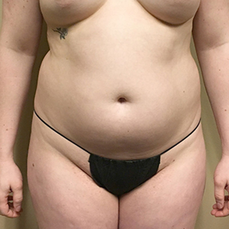 Liposuction Abdomen 01