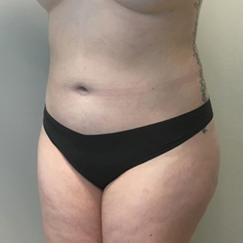 Liposuction Abdomen 03