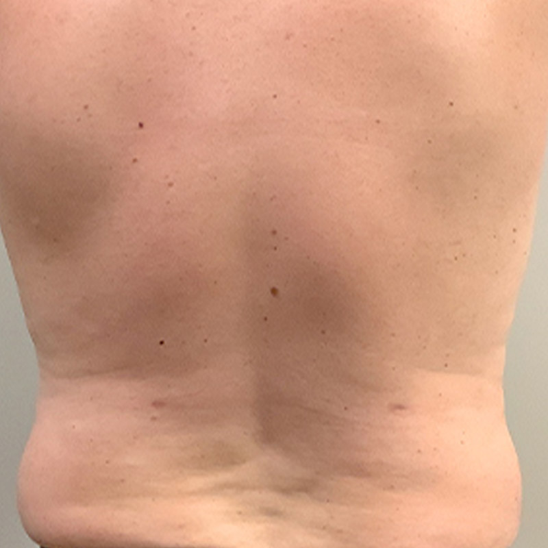 Liposuction Abdomen 03