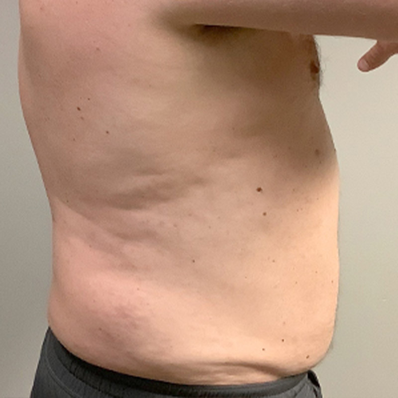 Liposuction Abdomen 07