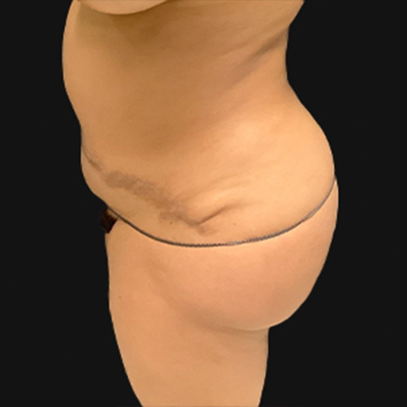 Liposuction Abdomen 03