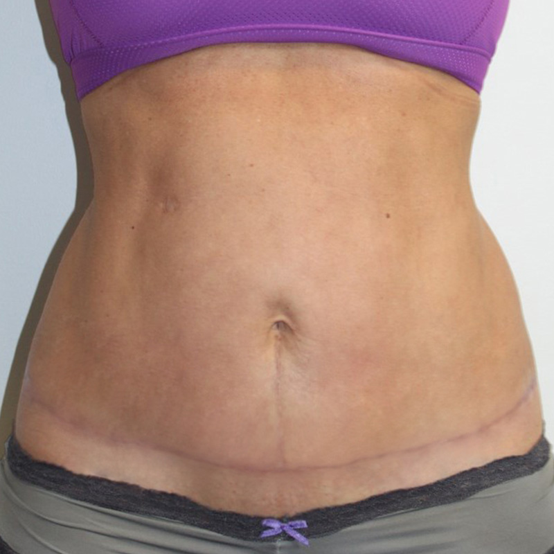 Liposuction Abdomen 19