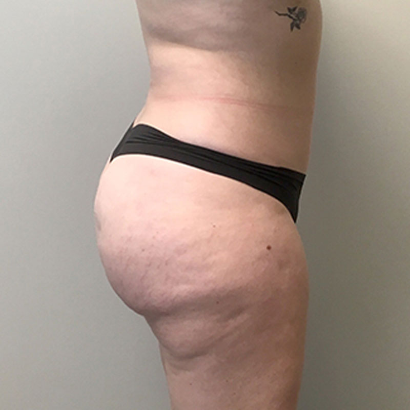 Liposuction Abdomen 05