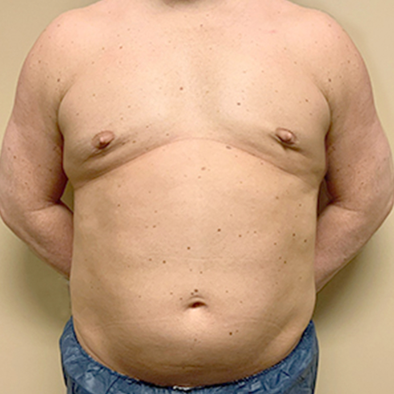 Liposuction Abdomen 01