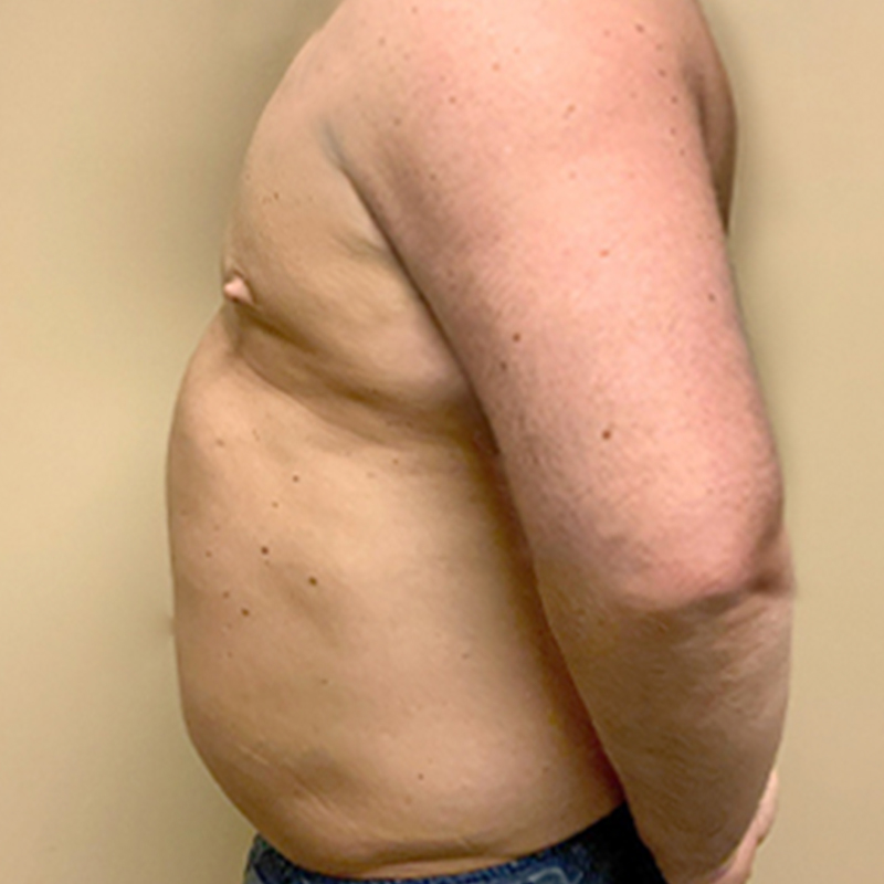 Liposuction Abdomen 05