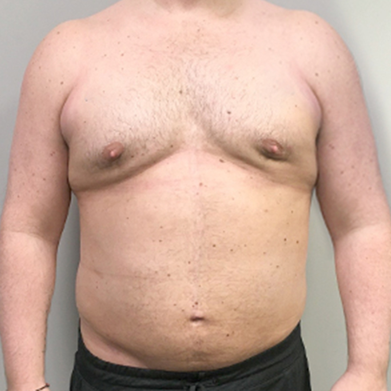 Liposuction Abdomen 07