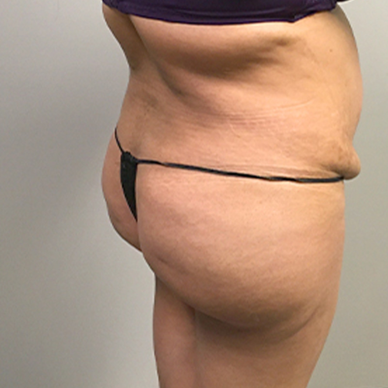 Liposuction Abdomen 07
