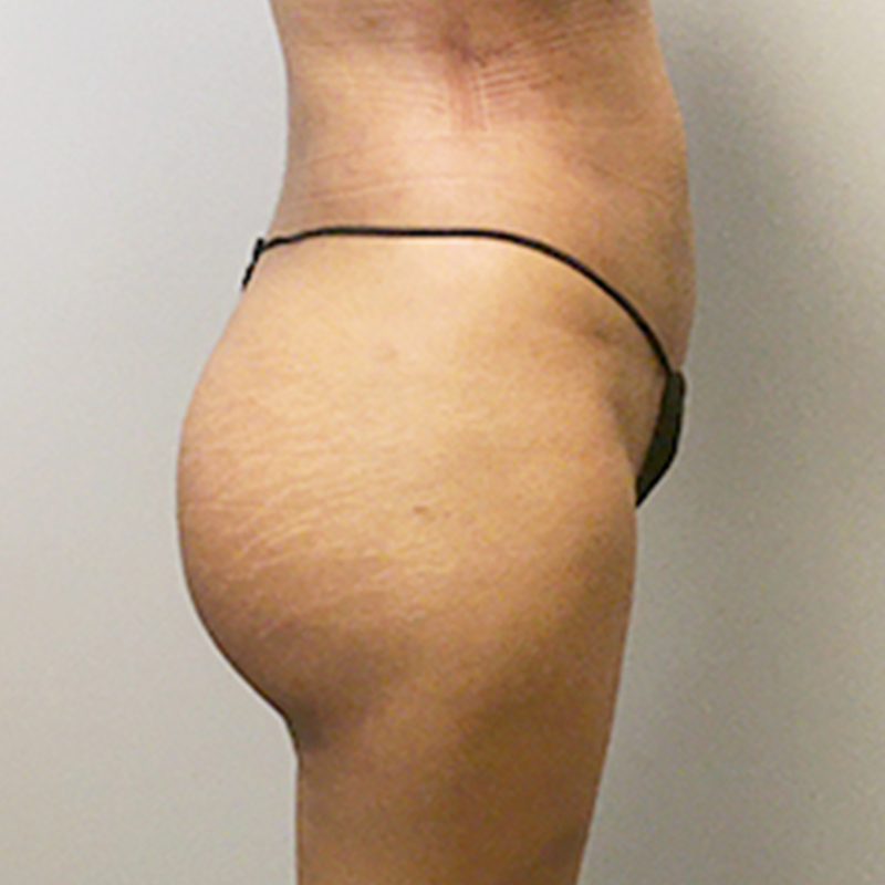 Liposuction Abdomen 07
