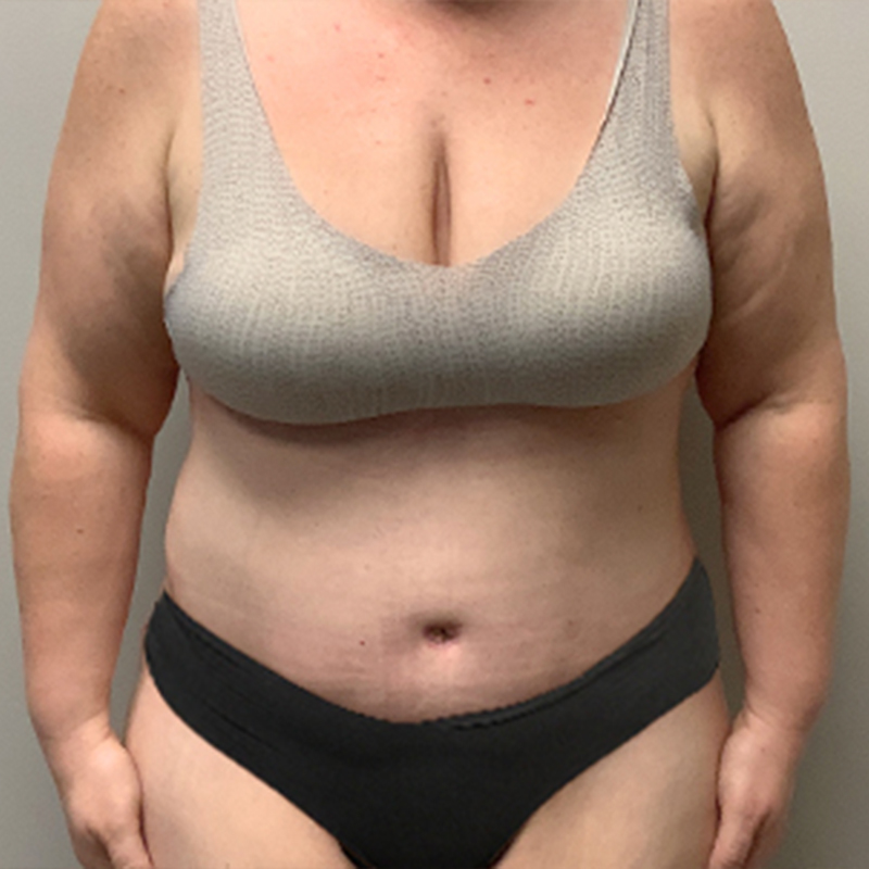 Liposuction Abdomen 30