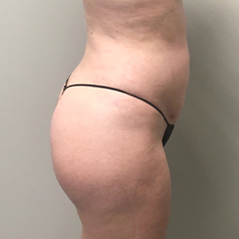 Liposuction Abdomen 09