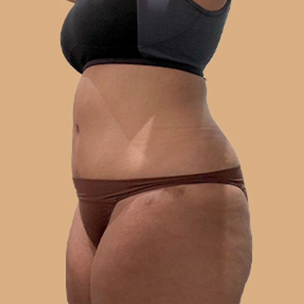 Liposuction Abdomen 05