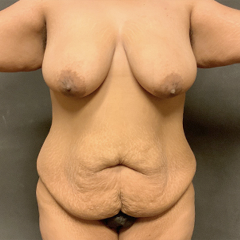 Liposuction Abdomen 01