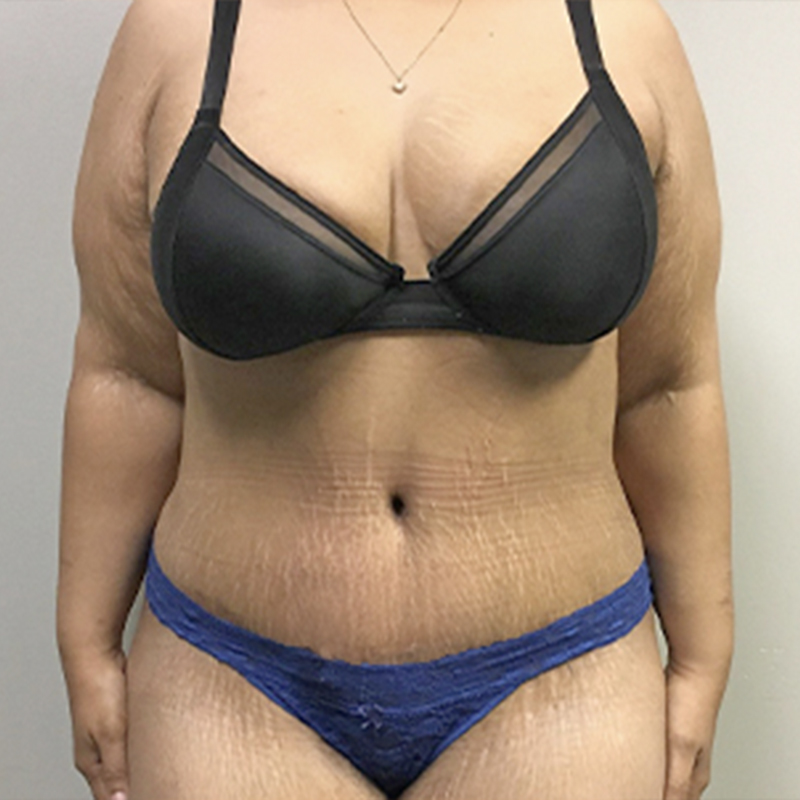 Liposuction Abdomen 34