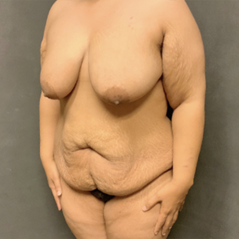 Liposuction Abdomen 03