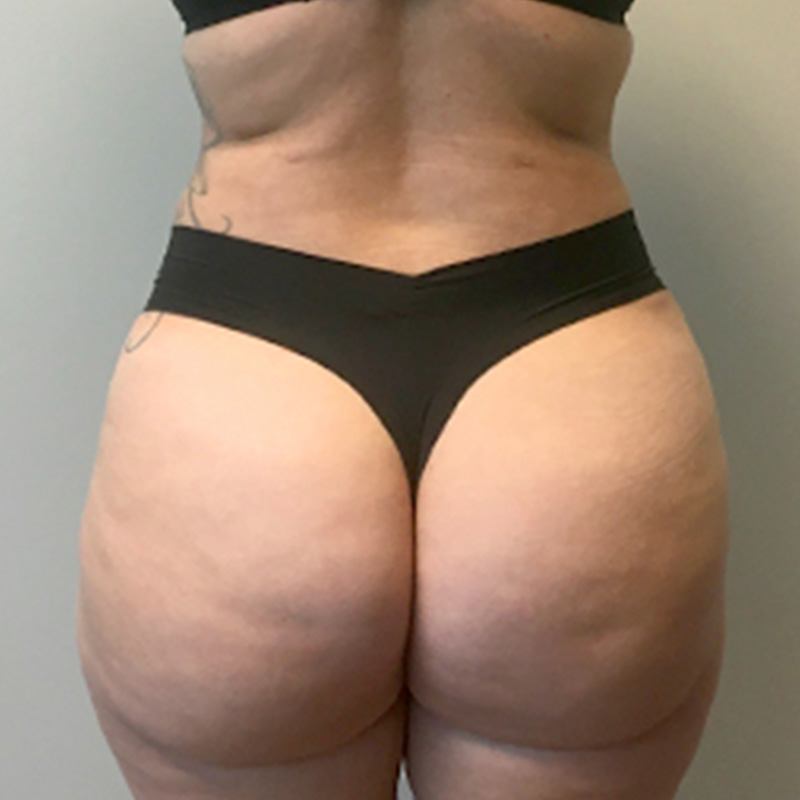 Liposuction Hips 01