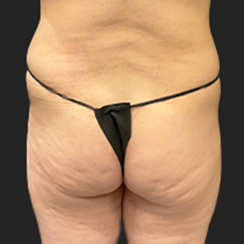 Liposuction Hips 01