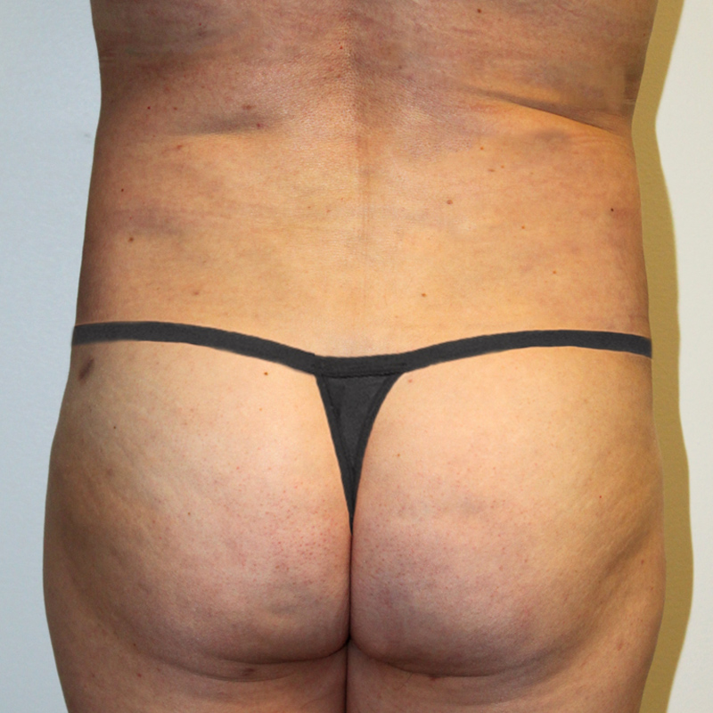 Liposuction Hips 03
