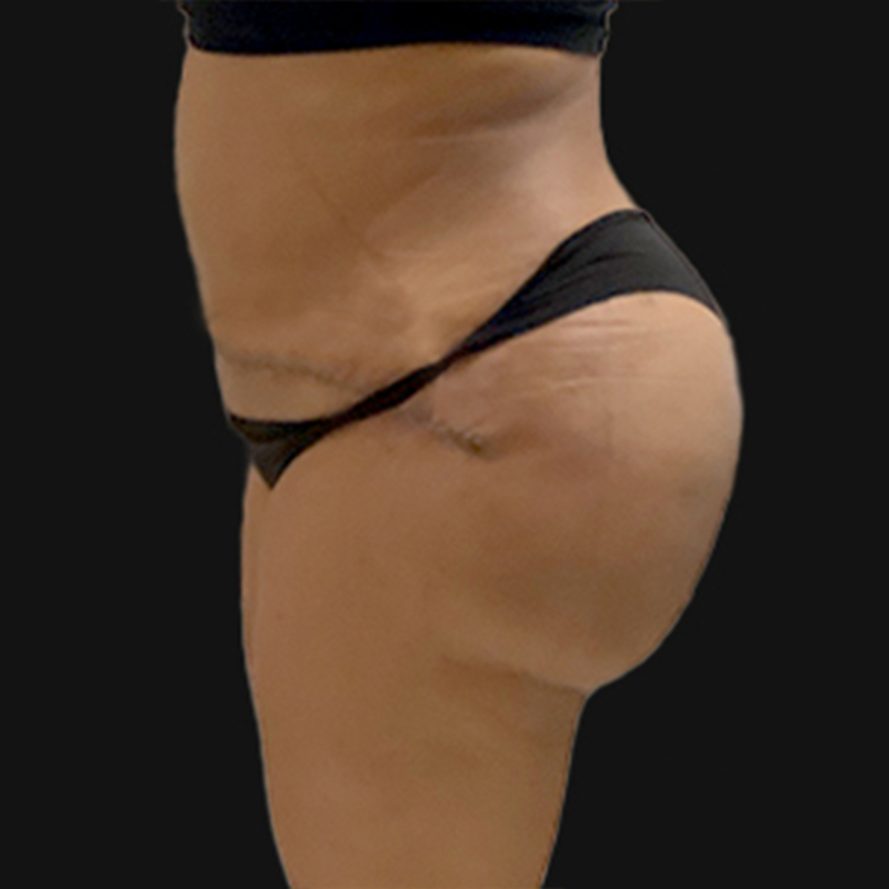 Liposuction Hips 03