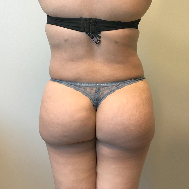 Liposuction Hips 10