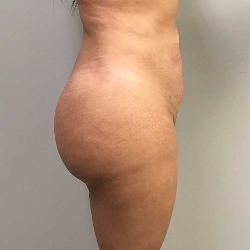 Liposuction Hips 03