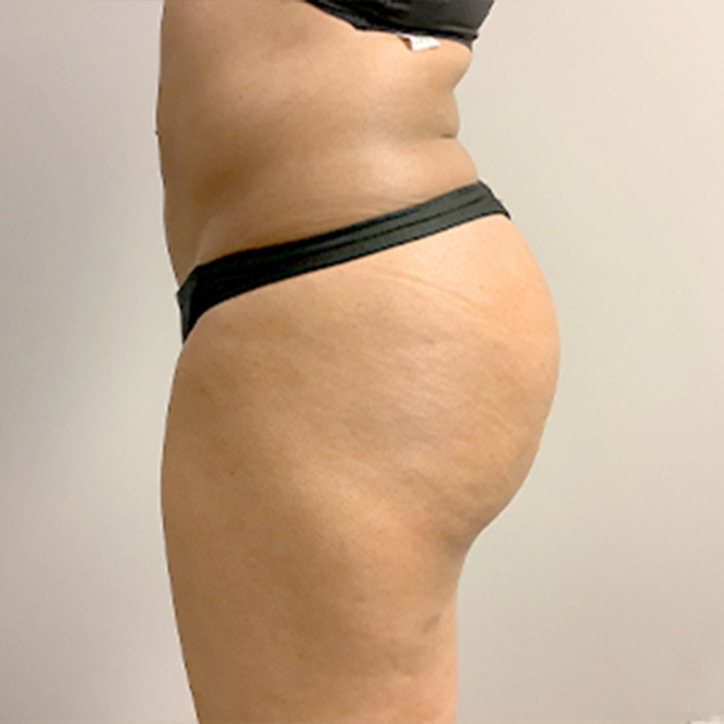 Liposuction Hips 05