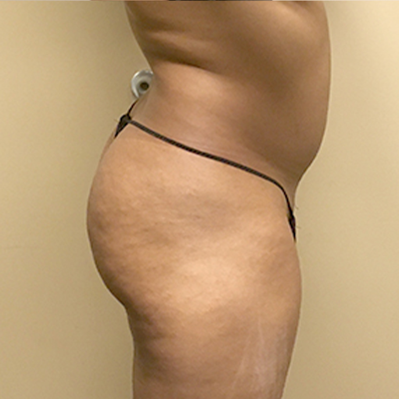 Liposuction Hips 09
