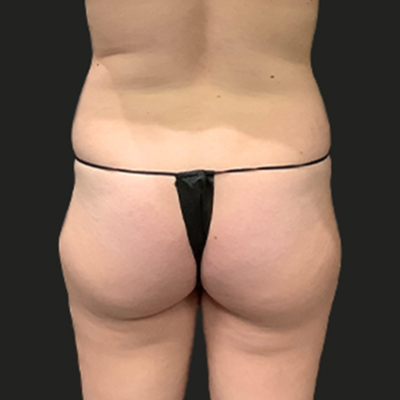 Liposuction Hips 01