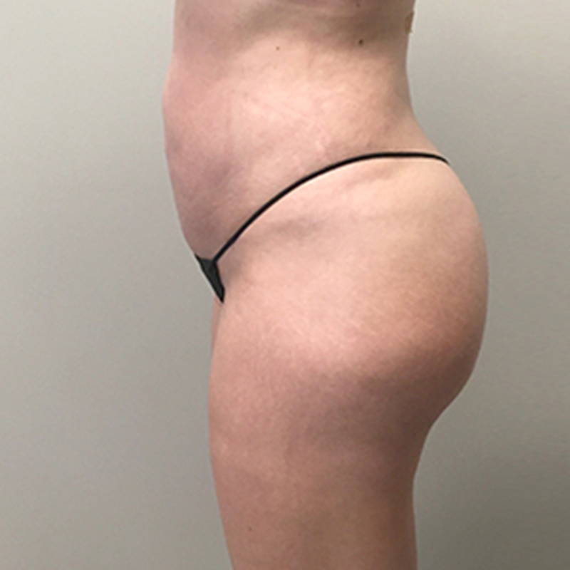 Liposuction Hips 03