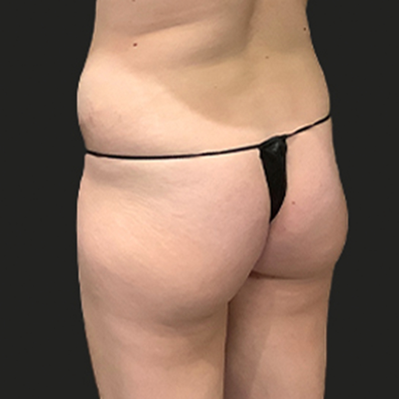 Liposuction Hips 05