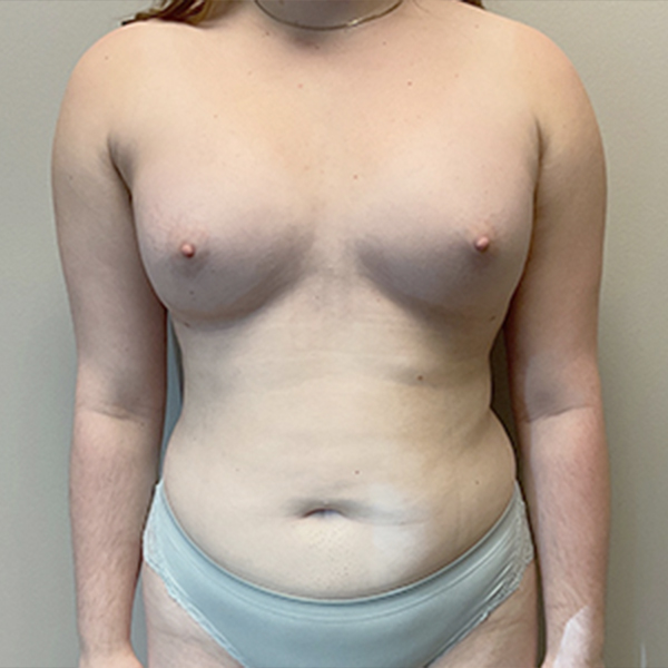 Liposuction Hips 16