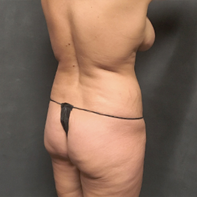 Liposuction Hips 05