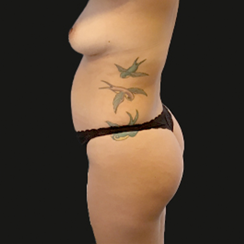 Liposuction Hips 09