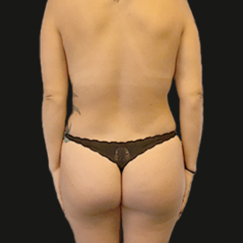 Liposuction Hips 11