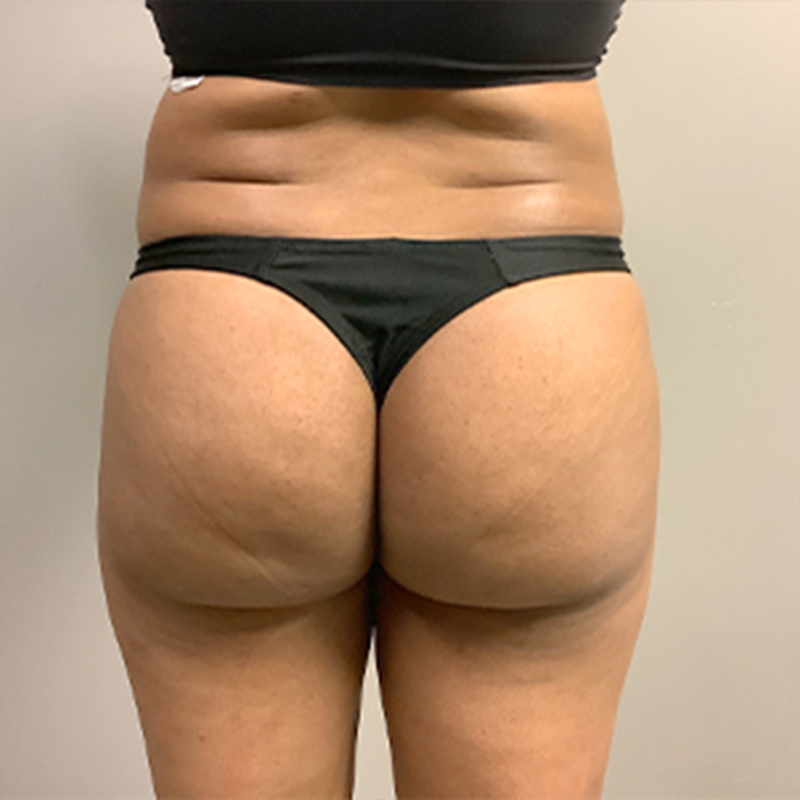 Liposuction Inner And Outer Thighs 03