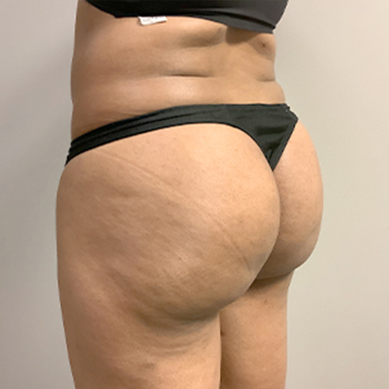 Liposuction Inner And Outer Thighs 03