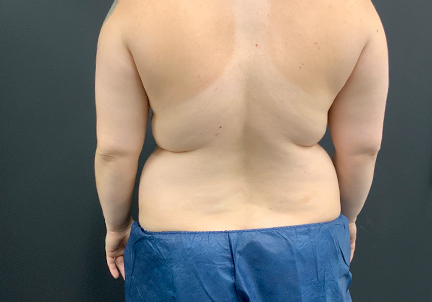 Liposuction Lower Back 01