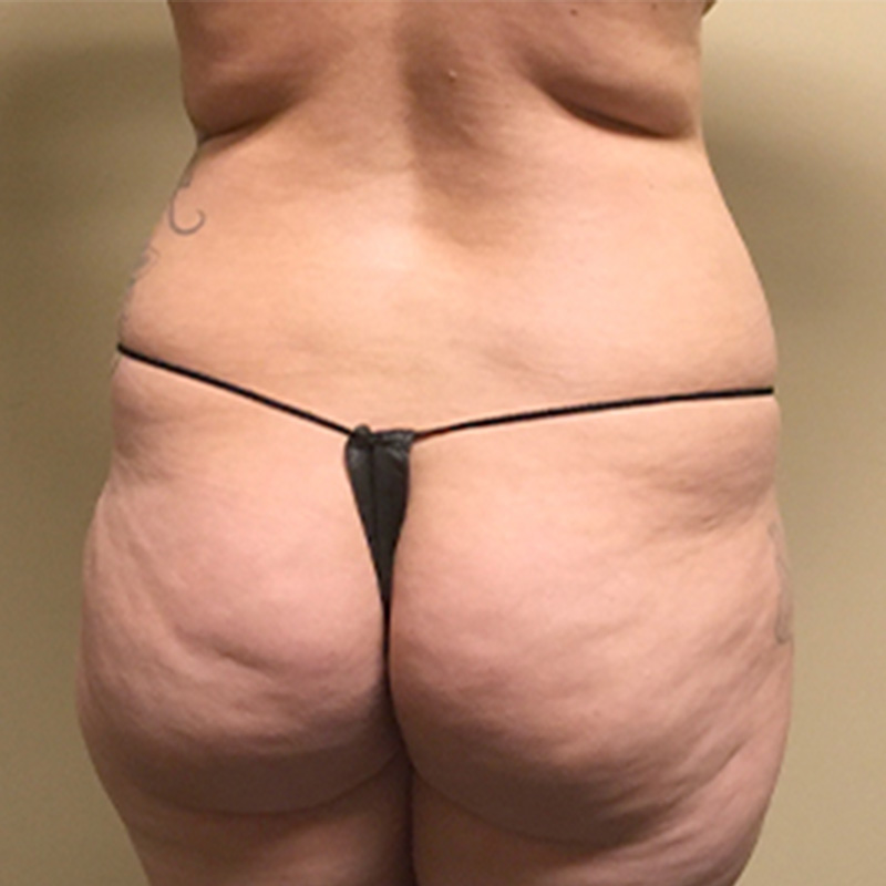 Liposuction Lower Back 01