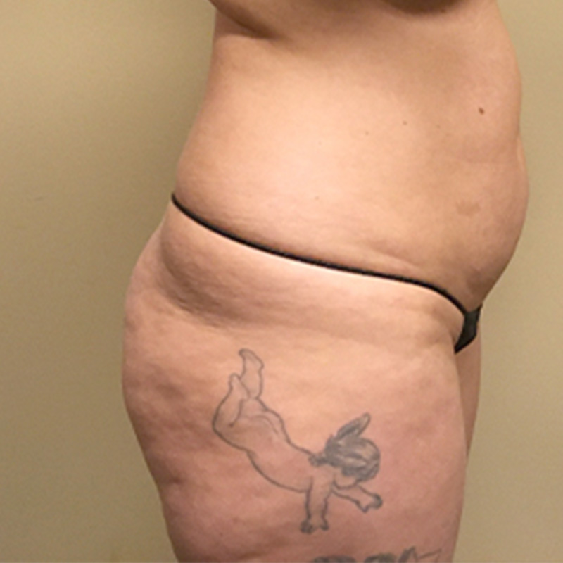 Liposuction Lower Back 05