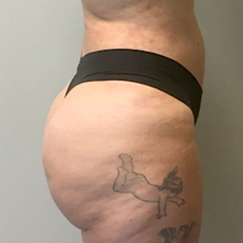 Liposuction Lower Back 05