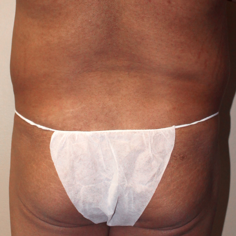Liposuction Lower Back 01