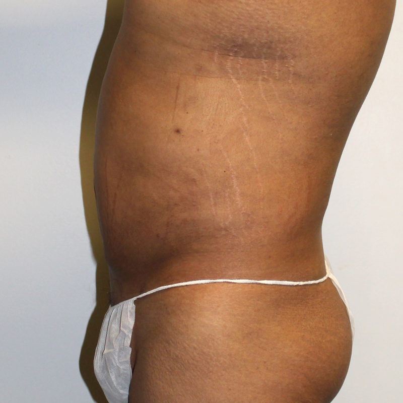 Liposuction Lower Back 03