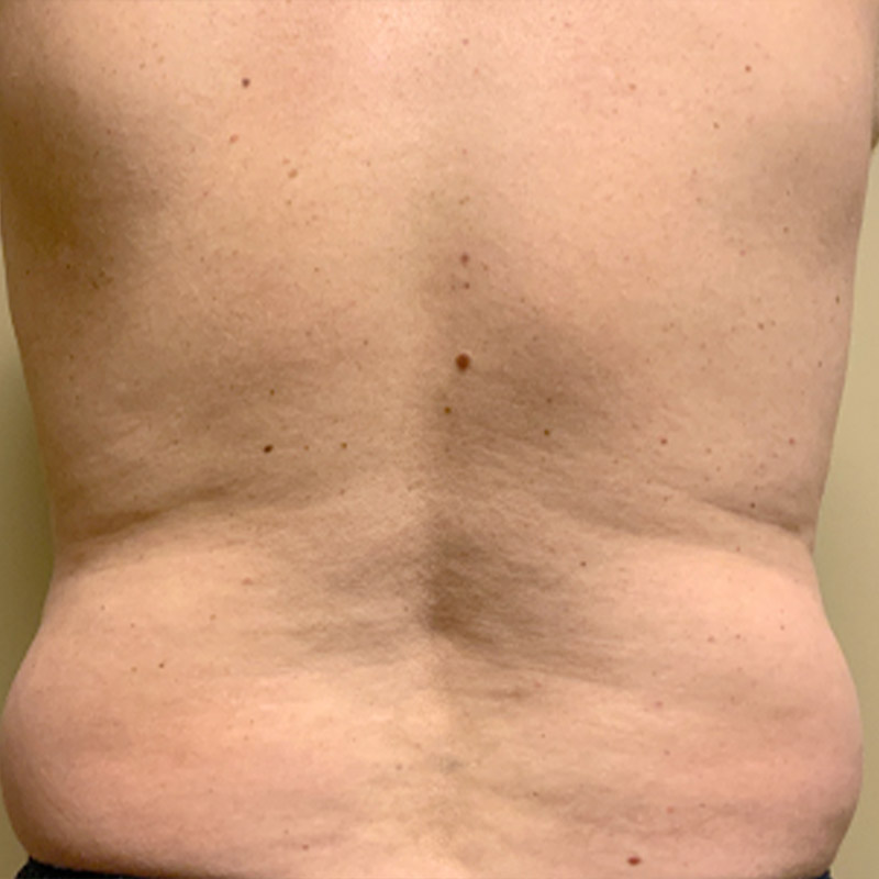Liposuction Lower Back 03