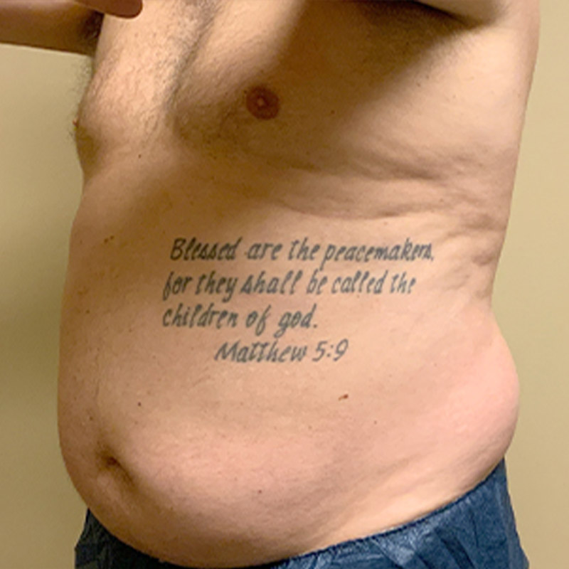 Liposuction Lower Back 05