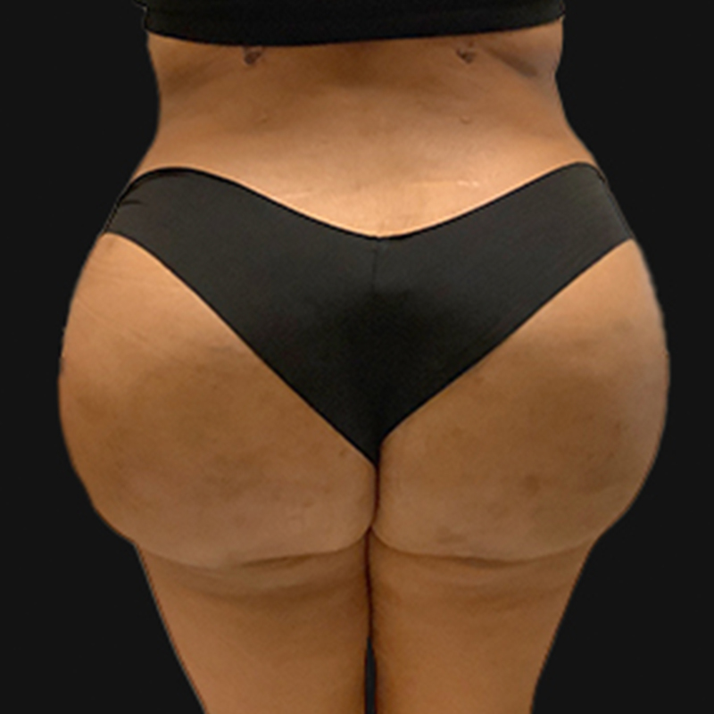 Liposuction Lower Back 09