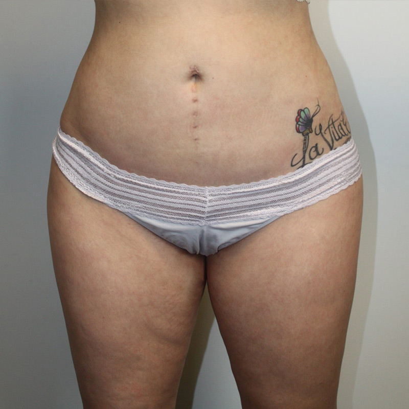 Liposuction Lower Back 15