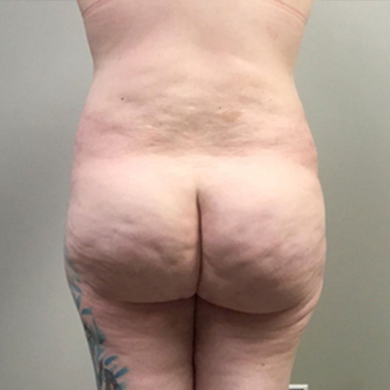 Liposuction Lower Back 16
