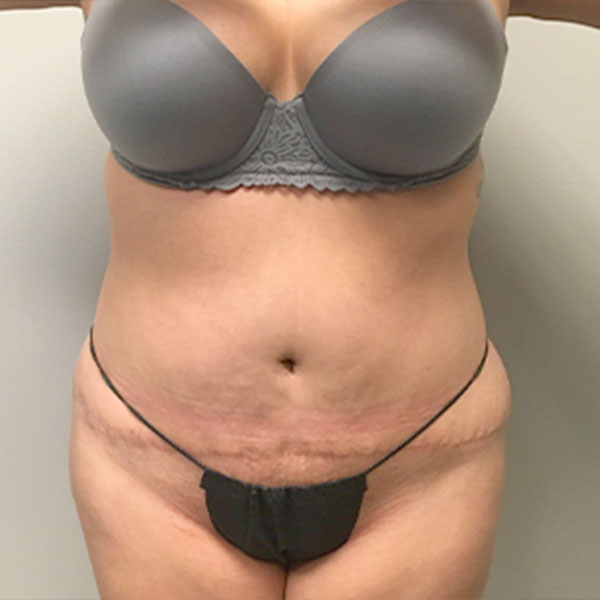 Liposuction Lower Back 21