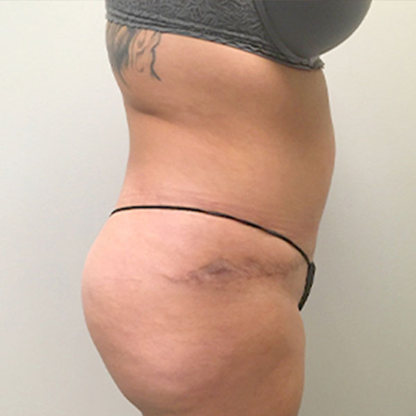 Liposuction Lower Back 07