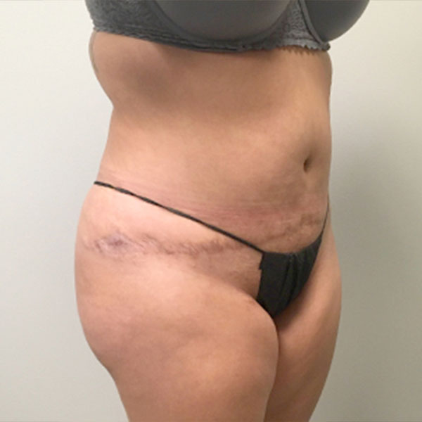 Liposuction Lower Back 09