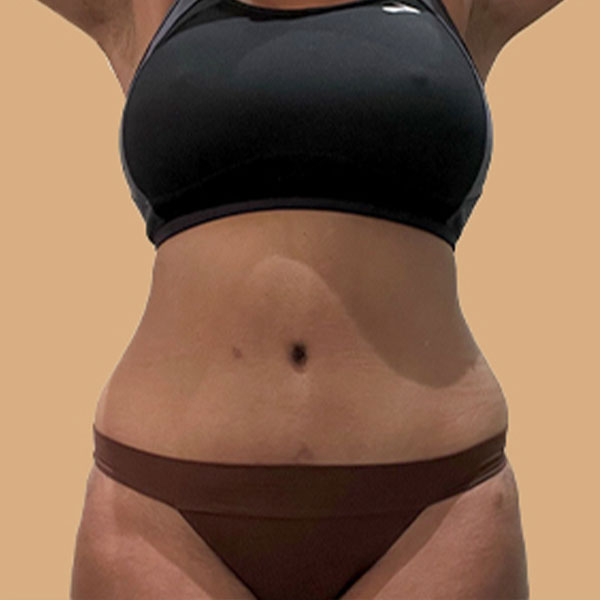 Liposuction Lower Back 22